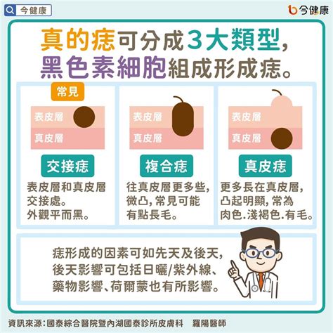 生黑痣|是痣or皮膚癌？醫「1張圖秒對照」 長這2部位最危險